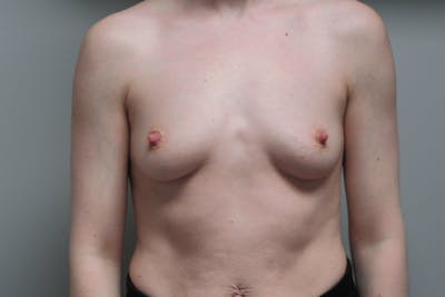 Breast Augmentation Before & After Gallery - Patient 108028 - Image 1