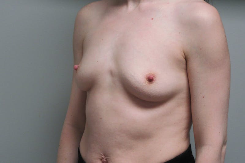 Breast Augmentation Before & After Gallery - Patient 108028 - Image 5