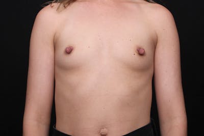 Breast Augmentation Before & After Gallery - Patient 368976 - Image 1