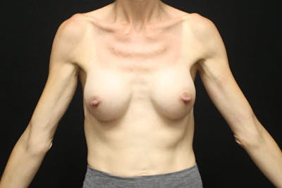 Breast Augmentation Before & After Gallery - Patient 202418 - Image 2
