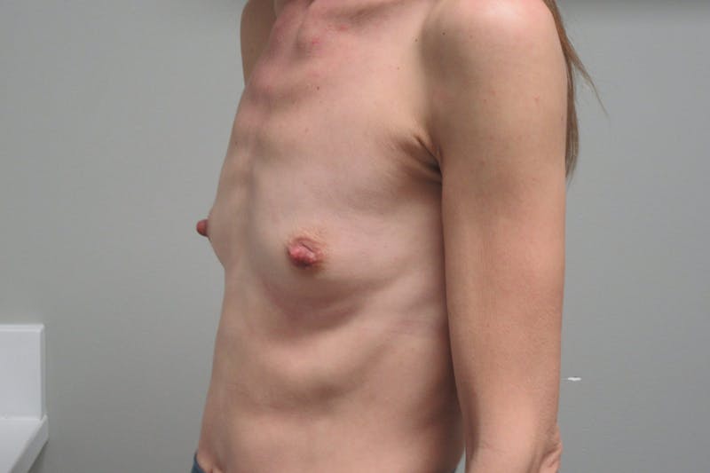Breast Augmentation Before & After Gallery - Patient 202418 - Image 3
