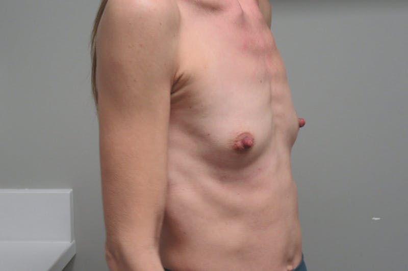 Breast Augmentation Before & After Gallery - Patient 202418 - Image 5