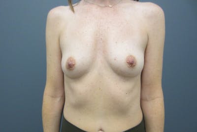 Breast Augmentation Before & After Gallery - Patient 817832 - Image 1
