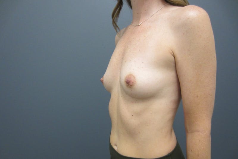 Breast Augmentation Before & After Gallery - Patient 817832 - Image 3