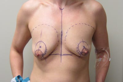 Breast Augmentation with Lift Before & After Gallery - Patient 312514 - Image 1
