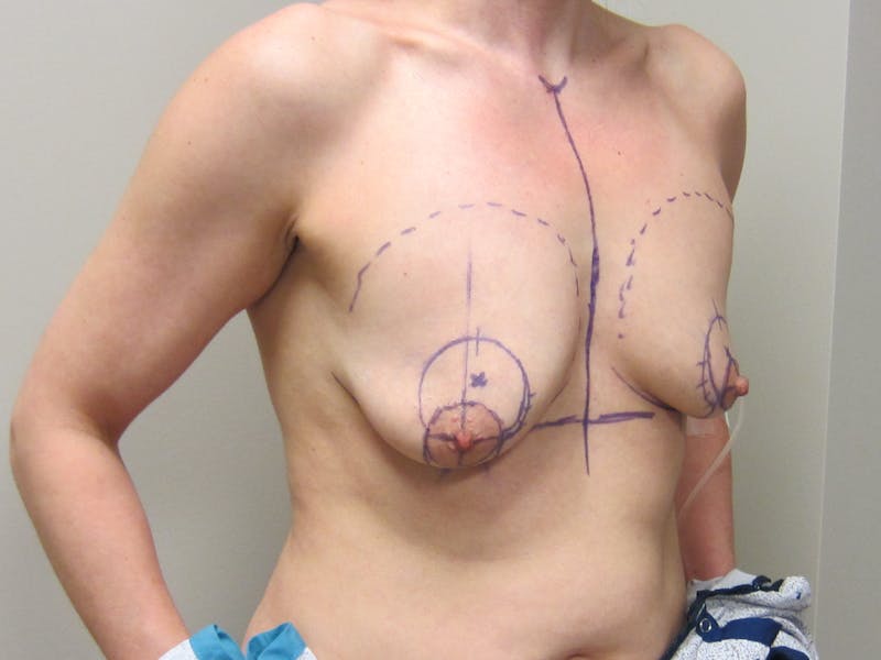 Breast Augmentation with Lift Before & After Gallery - Patient 312514 - Image 5