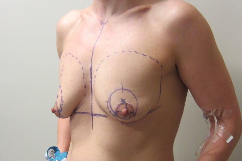 Breast Augmentation with Lift Before & After Gallery - Patient 312514 - Image 3