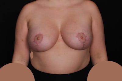 Breast Augmentation with Lift Before & After Gallery - Patient 292625 - Image 2