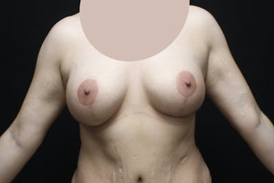 Breast Augmentation with Lift Before & After Gallery - Patient 228850 - Image 2