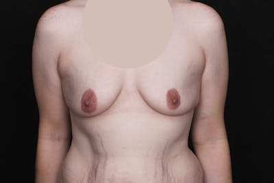 Breast Augmentation with Lift Before & After Gallery - Patient 228850 - Image 1