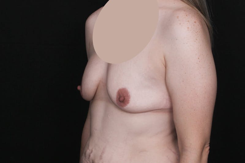 Breast Augmentation with Lift Before & After Gallery - Patient 228850 - Image 3