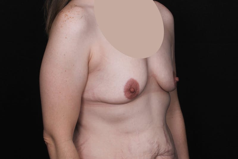 Breast Augmentation with Lift Before & After Gallery - Patient 228850 - Image 5
