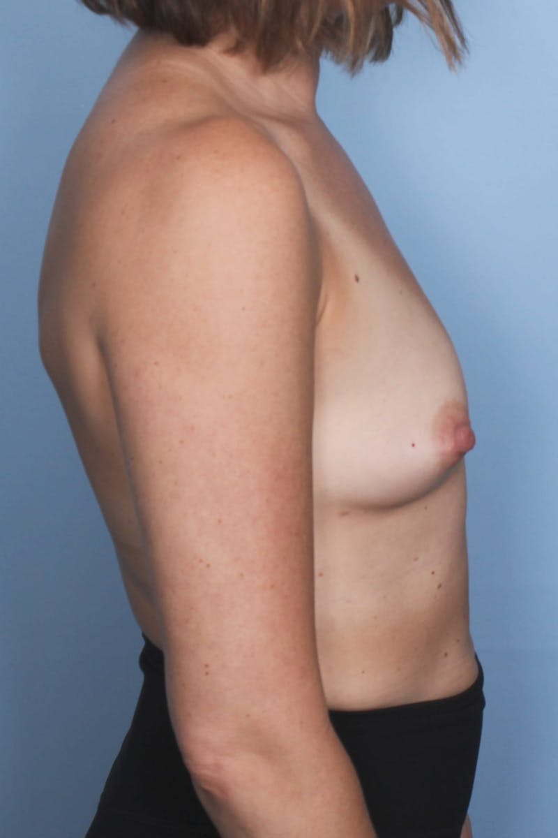 Fat Grafting Breast Augmentation Before & After Gallery - Patient 367761 - Image 4