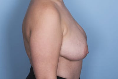 Fat Grafting Breast Augmentation Before & After Gallery - Patient 312264 - Image 2
