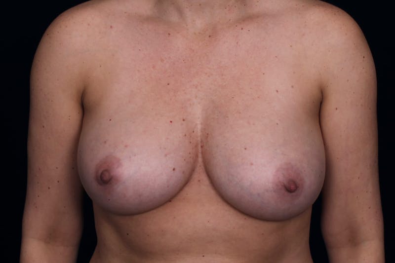 Fat Grafting Breast Augmentation Before & After Gallery - Patient 250121 - Image 2