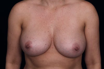 Fat Grafting Breast Augmentation Before & After Gallery - Patient 250121 - Image 2