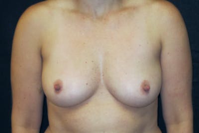Fat Grafting Breast Augmentation Before & After Gallery - Patient 250121 - Image 1