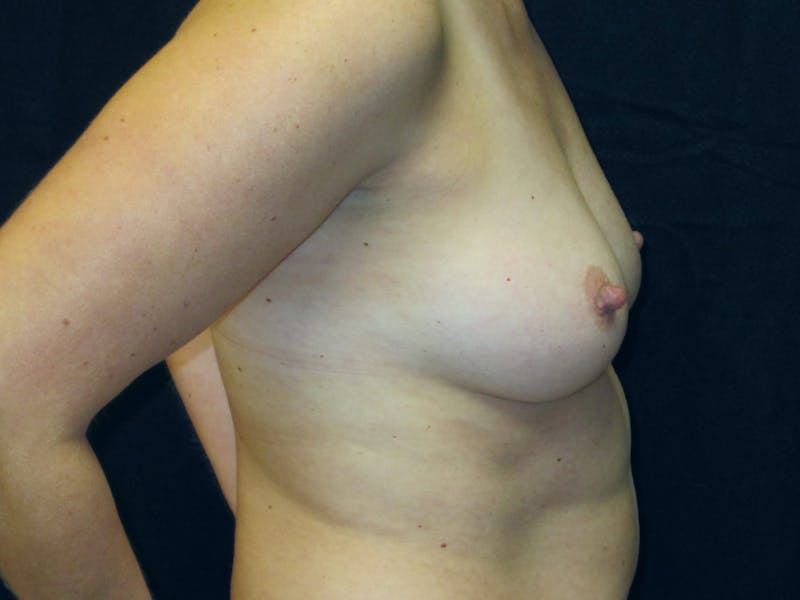 Fat Grafting Breast Augmentation Before & After Gallery - Patient 250121 - Image 5
