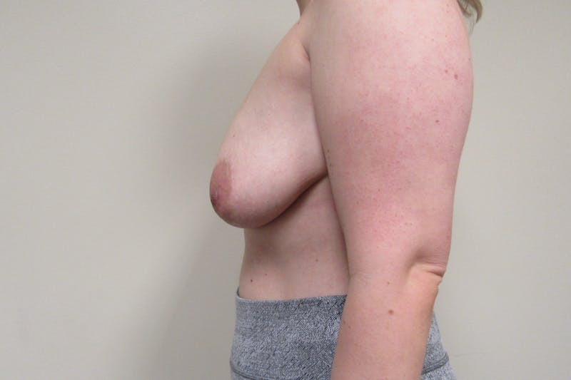 Fat Grafting Breast Augmentation with Lift Before & After Gallery - Patient 249681 - Image 5