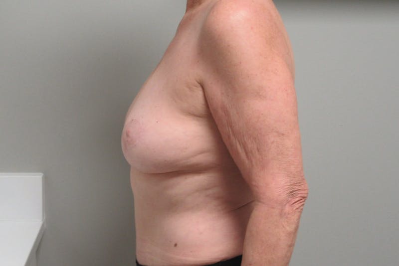 Fat Grafting Breast Augmentation with Lift Before & After Gallery - Patient 187399 - Image 4
