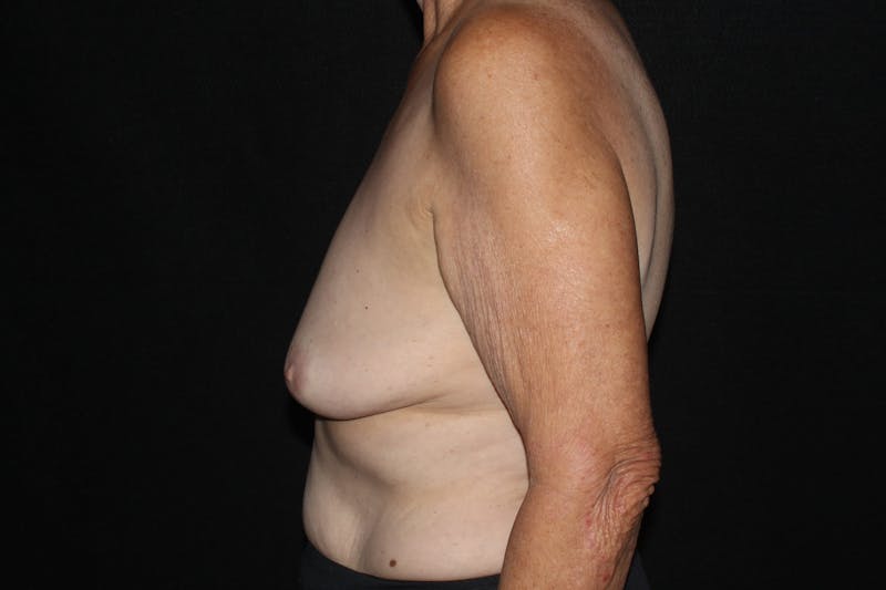 Fat Grafting Breast Augmentation with Lift Before & After Gallery - Patient 187399 - Image 3