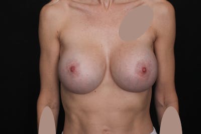 Breast Implant Revision Before & After Gallery - Patient 208899 - Image 2
