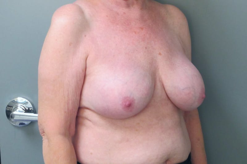 Breast Implant Revision Before & After Gallery - Patient 152287 - Image 4