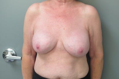 Breast Implant Revision Before & After Gallery - Patient 152287 - Image 2