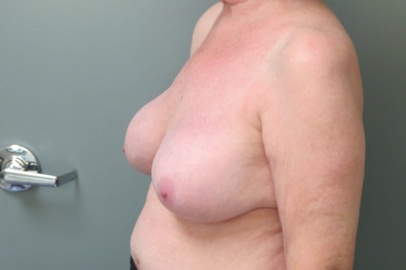 Breast Implant Revision Before & After Gallery - Patient 152287 - Image 6
