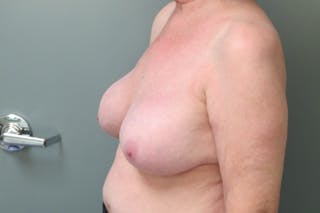 Breast Implant Revision Before & After Gallery - Patient 152287 - Image 6