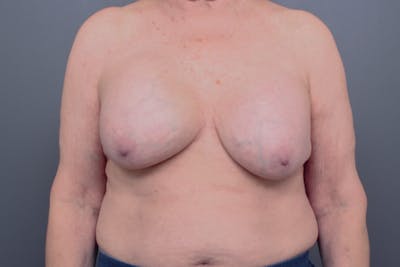 Breast Implant Revision Before & After Gallery - Patient 152287 - Image 1