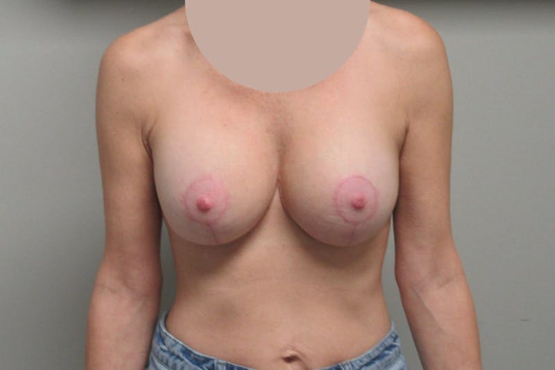 Breast Implant Revision with Lift Before & After Gallery - Patient 221089 - Image 2