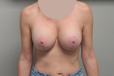 Breast Implant Revision with Lift Before & After Gallery - Patient 221089 - Image 2