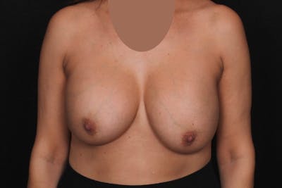 Breast Implant Revision with Lift Before & After Gallery - Patient 274729 - Image 1