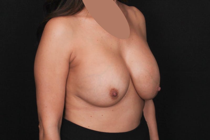 Breast Implant Revision with Lift Before & After Gallery - Patient 274729 - Image 5