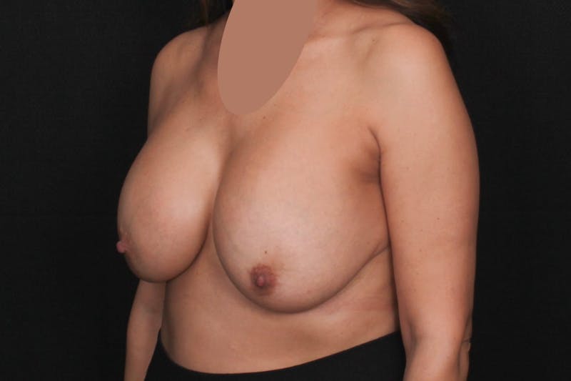 Breast Implant Revision with Lift Before & After Gallery - Patient 274729 - Image 3