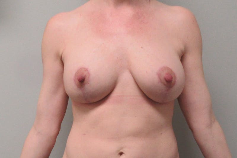 Breast Implant Revision with Lift Before & After Gallery - Patient 118800 - Image 2
