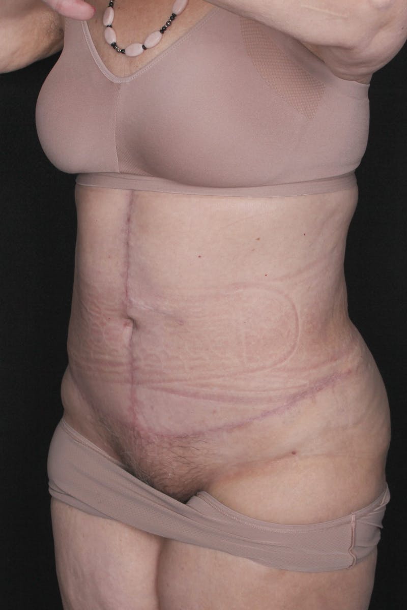 Fleur Di Lis Abdominoplasty Before & After Gallery - Patient 840866 - Image 4