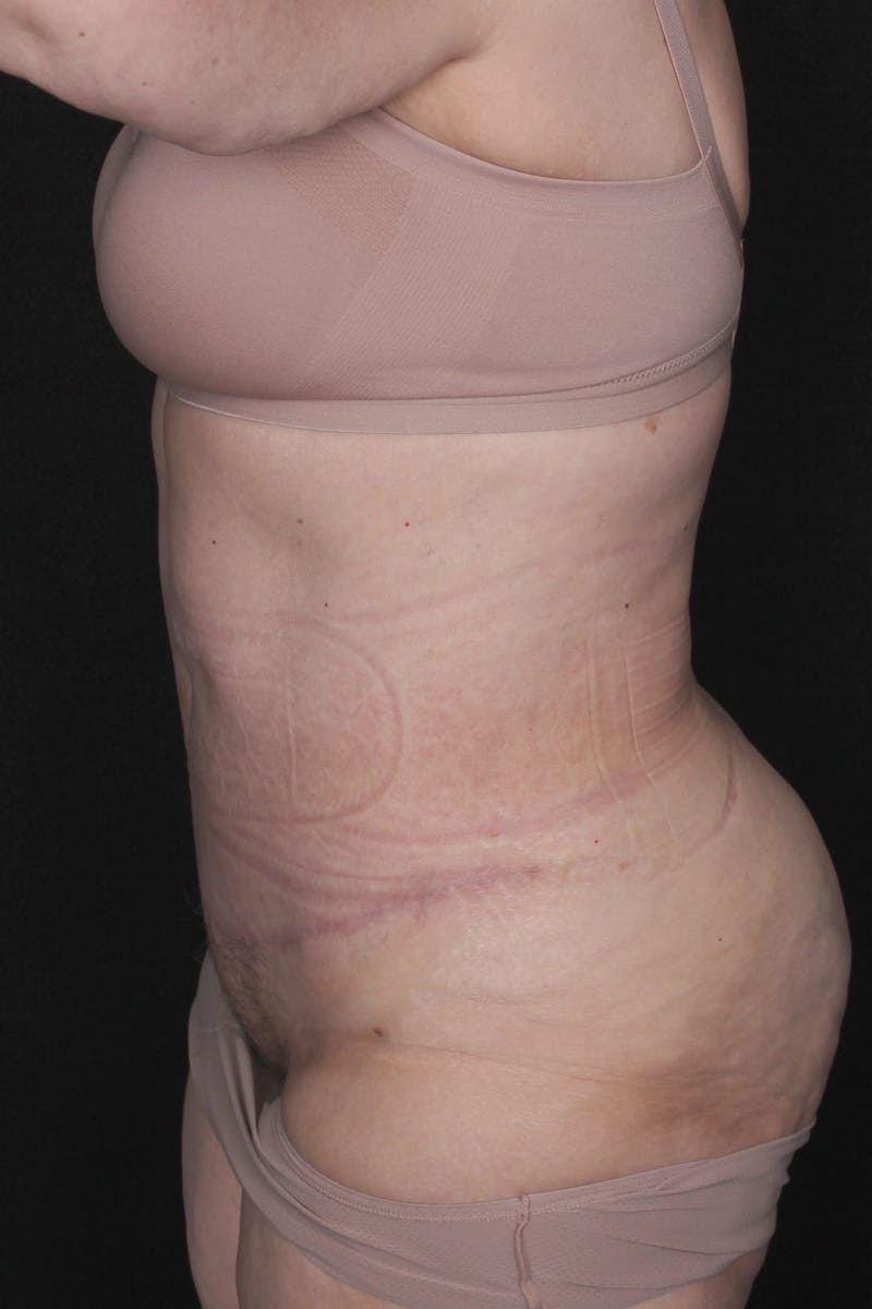 Fleur Di Lis Abdominoplasty Before & After Gallery - Patient 840866 - Image 8