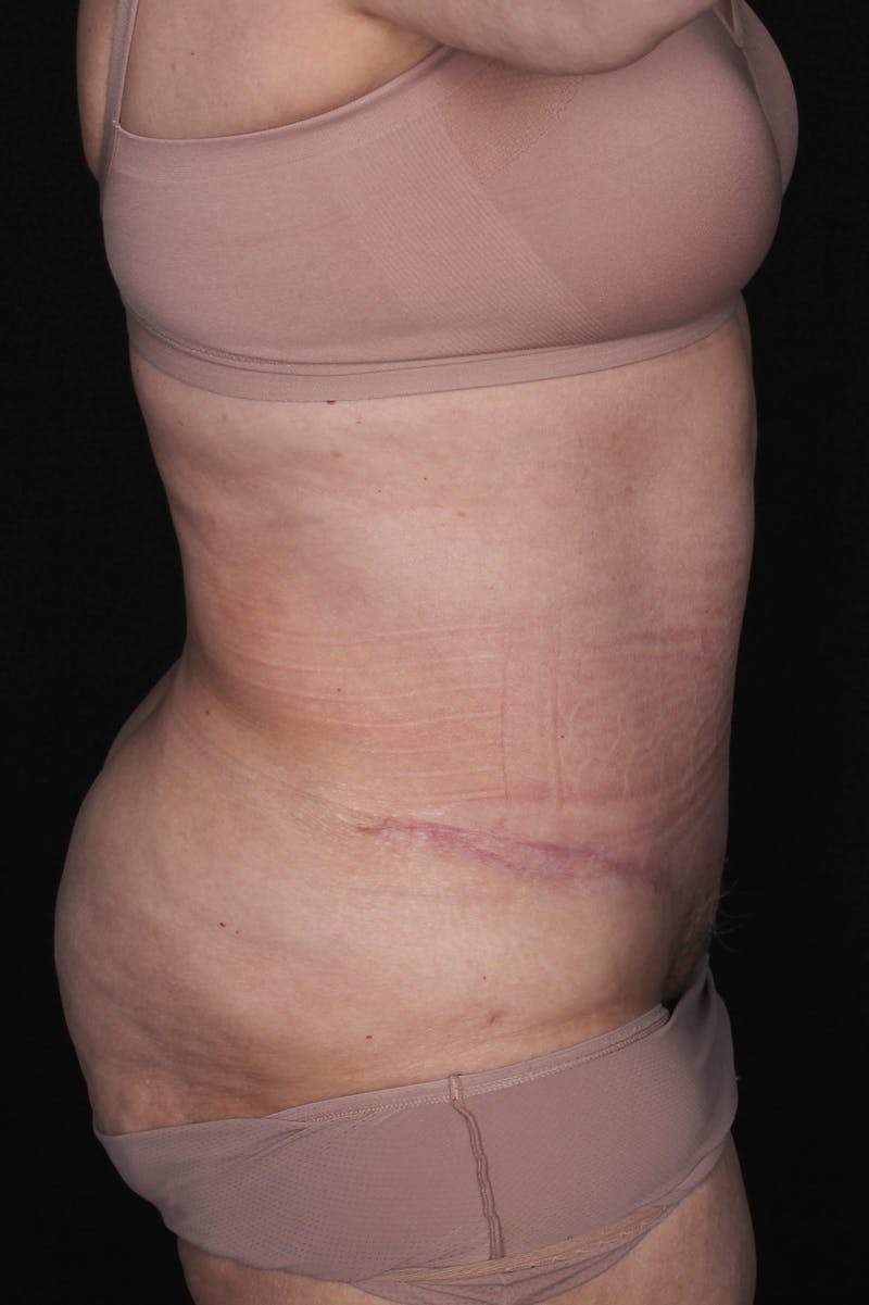 Fleur Di Lis Abdominoplasty Before & After Gallery - Patient 840866 - Image 10
