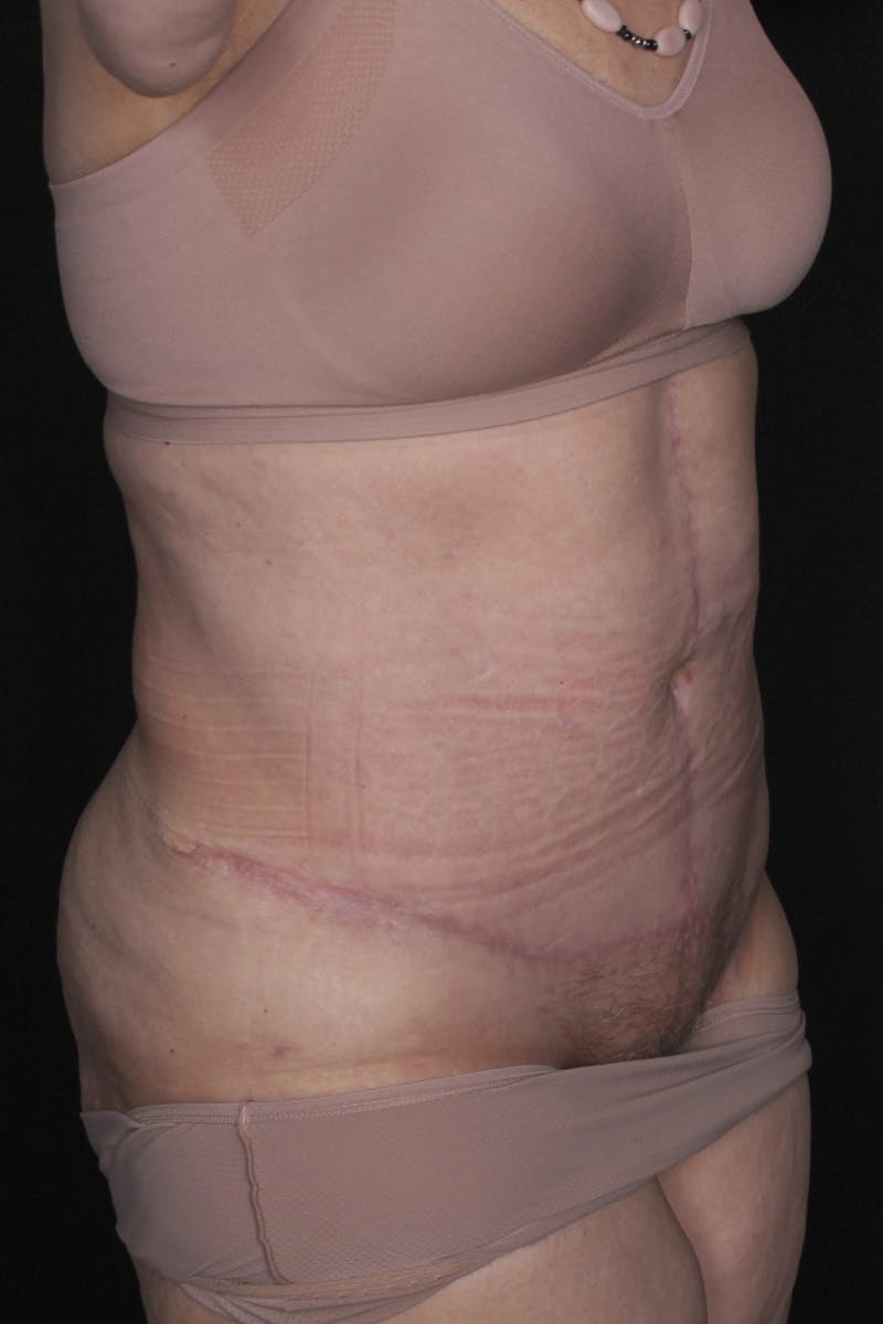 Fleur Di Lis Abdominoplasty Before & After Gallery - Patient 840866 - Image 6