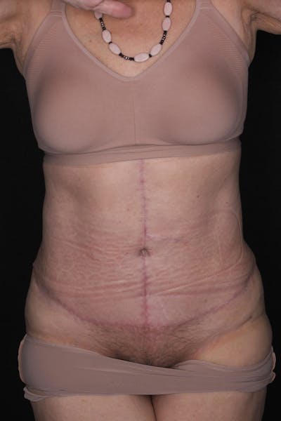 Fleur Di Lis Abdominoplasty Before & After Gallery - Patient 840866 - Image 2