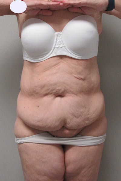 Fleur Di Lis Abdominoplasty Before & After Gallery - Patient 840866 - Image 1