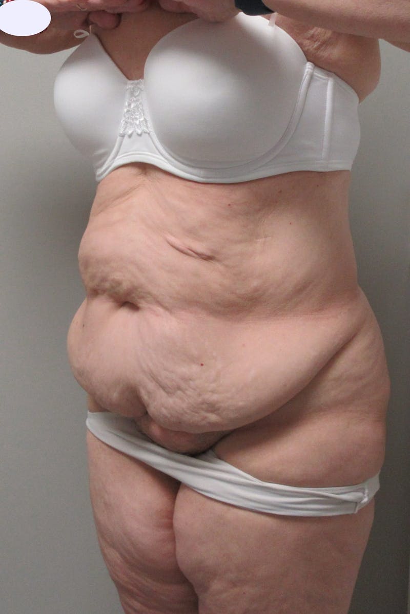Fleur Di Lis Abdominoplasty Before & After Gallery - Patient 840866 - Image 3