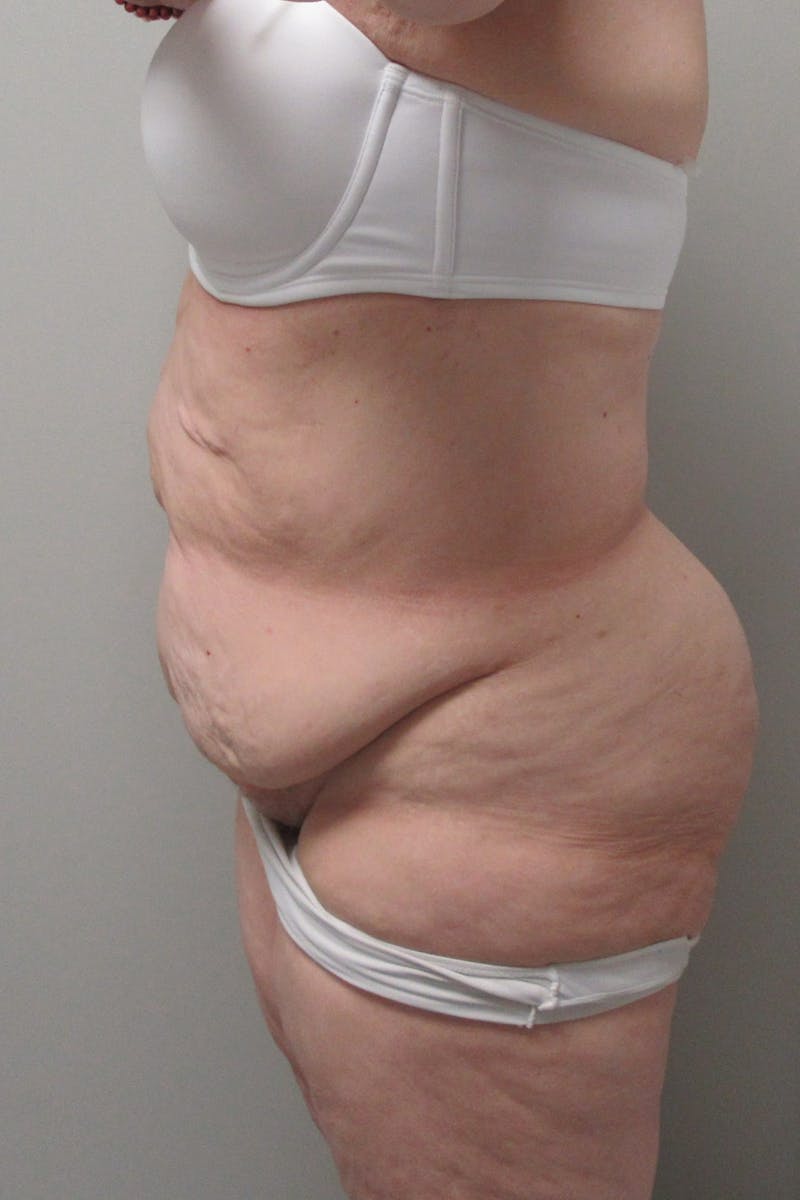 Fleur Di Lis Abdominoplasty Before & After Gallery - Patient 840866 - Image 5