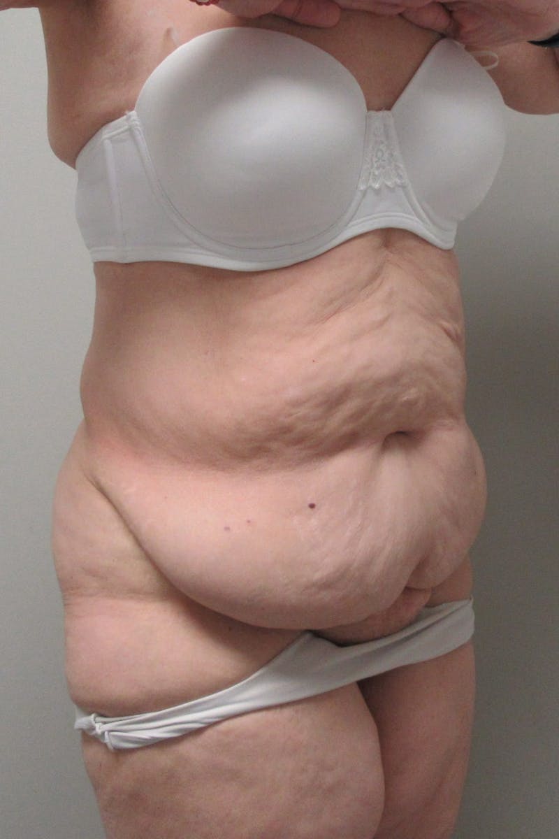 Fleur Di Lis Abdominoplasty Before & After Gallery - Patient 840866 - Image 7