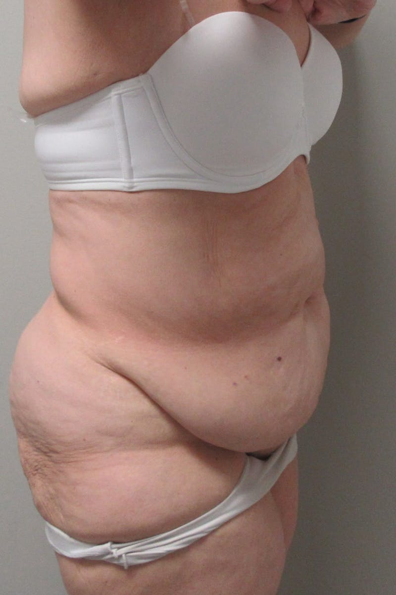 Fleur Di Lis Abdominoplasty Before & After Gallery - Patient 840866 - Image 9