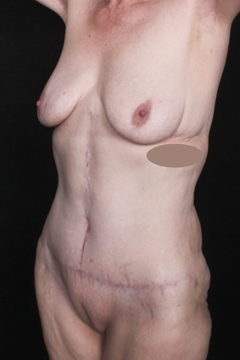 Fleur Di Lis Abdominoplasty Before & After Gallery - Patient 203316 - Image 10