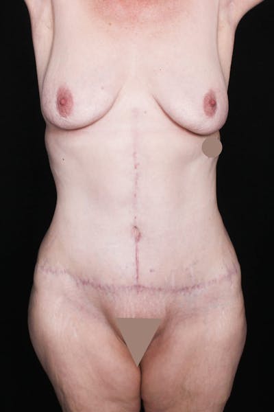 Fleur Di Lis Abdominoplasty Before & After Gallery - Patient 203316 - Image 2