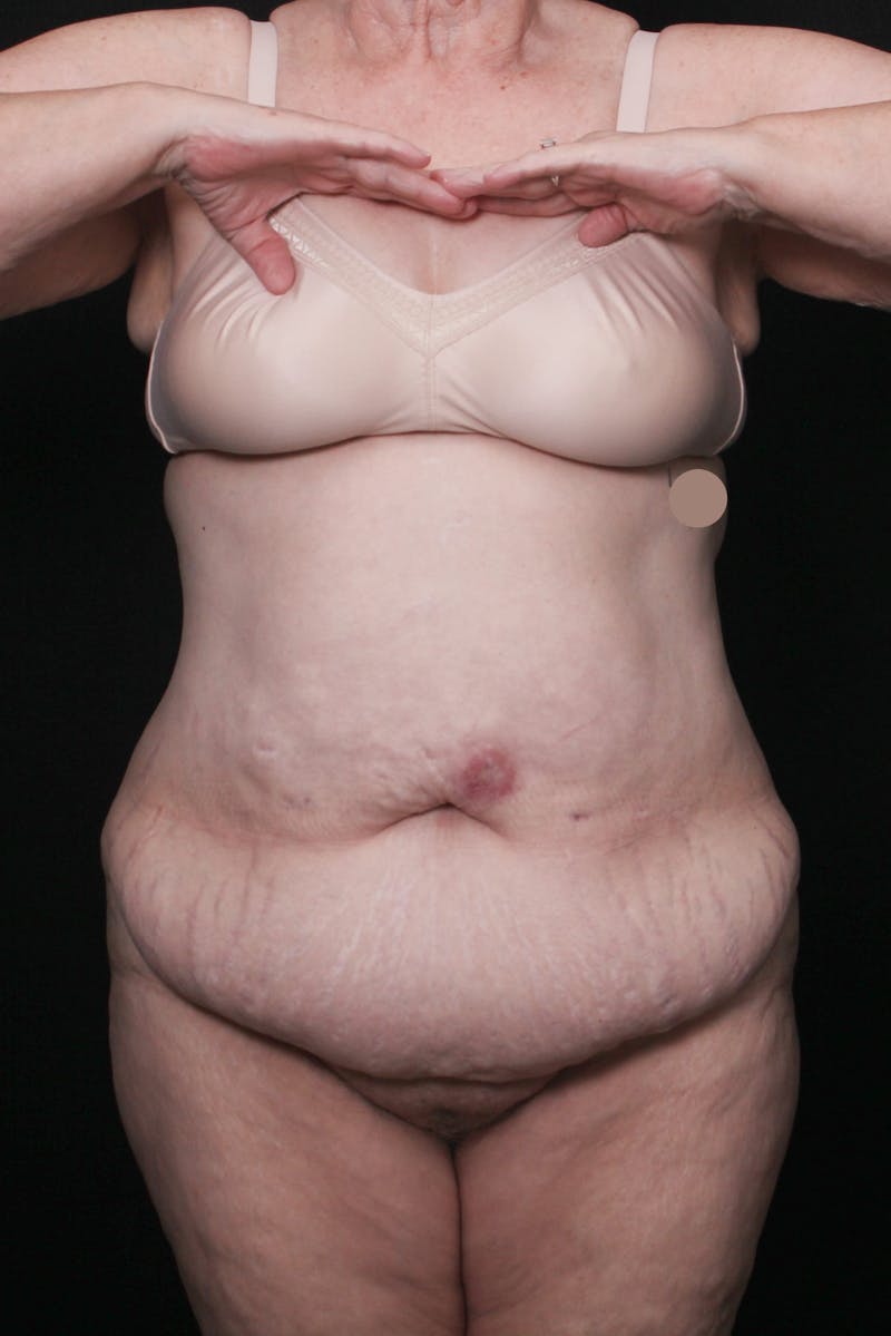 Fleur Di Lis Abdominoplasty Before & After Gallery - Patient 203316 - Image 1